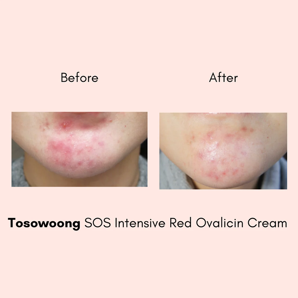 TOSOWOONG SOS Intensive Red Clinic Ovalicin Skin Clear Cream 50g - KLO