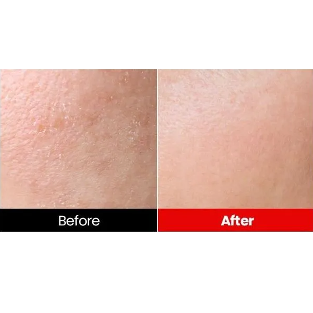 Dr.want Acne Red Foam 100ml - KLO