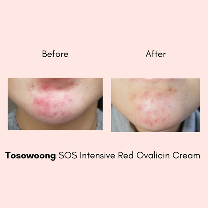 TOSOWOONG SOS Intensive Red Clinic Ovalicin Skin Clear Cream 50g - DODOSKIN